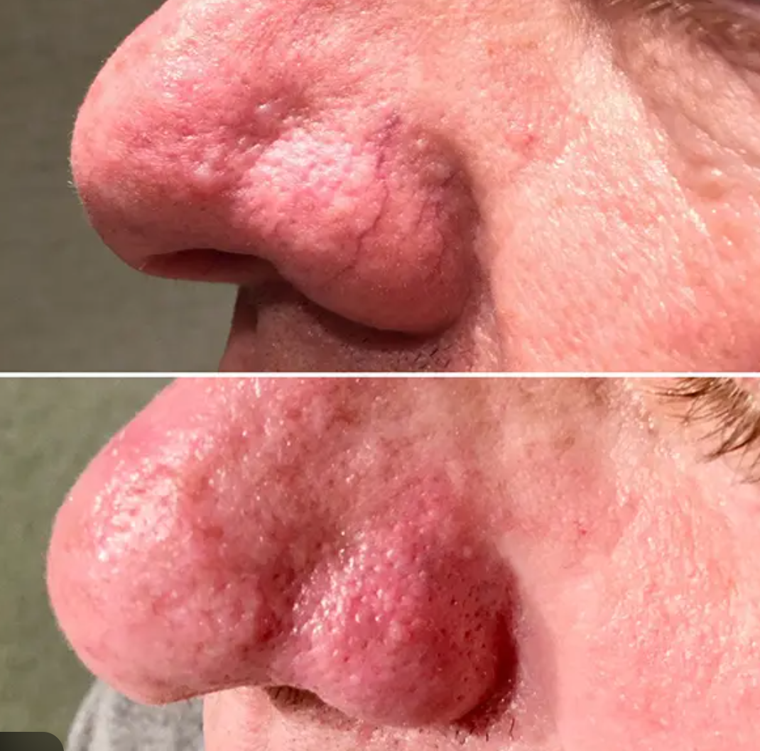 anti-télangiéctasies